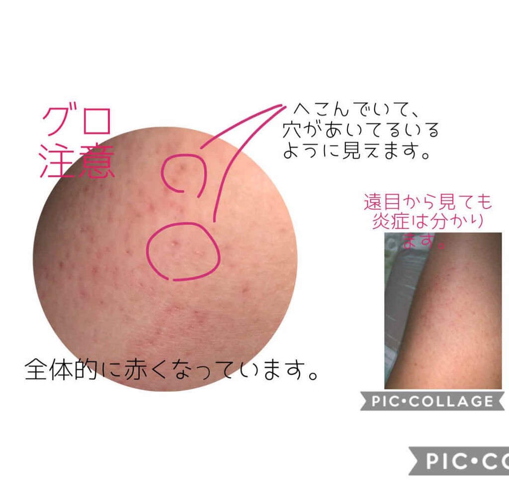 除毛クリームキット敏感肌用/エピラット/除毛クリームを使ったクチコミ（3枚目）