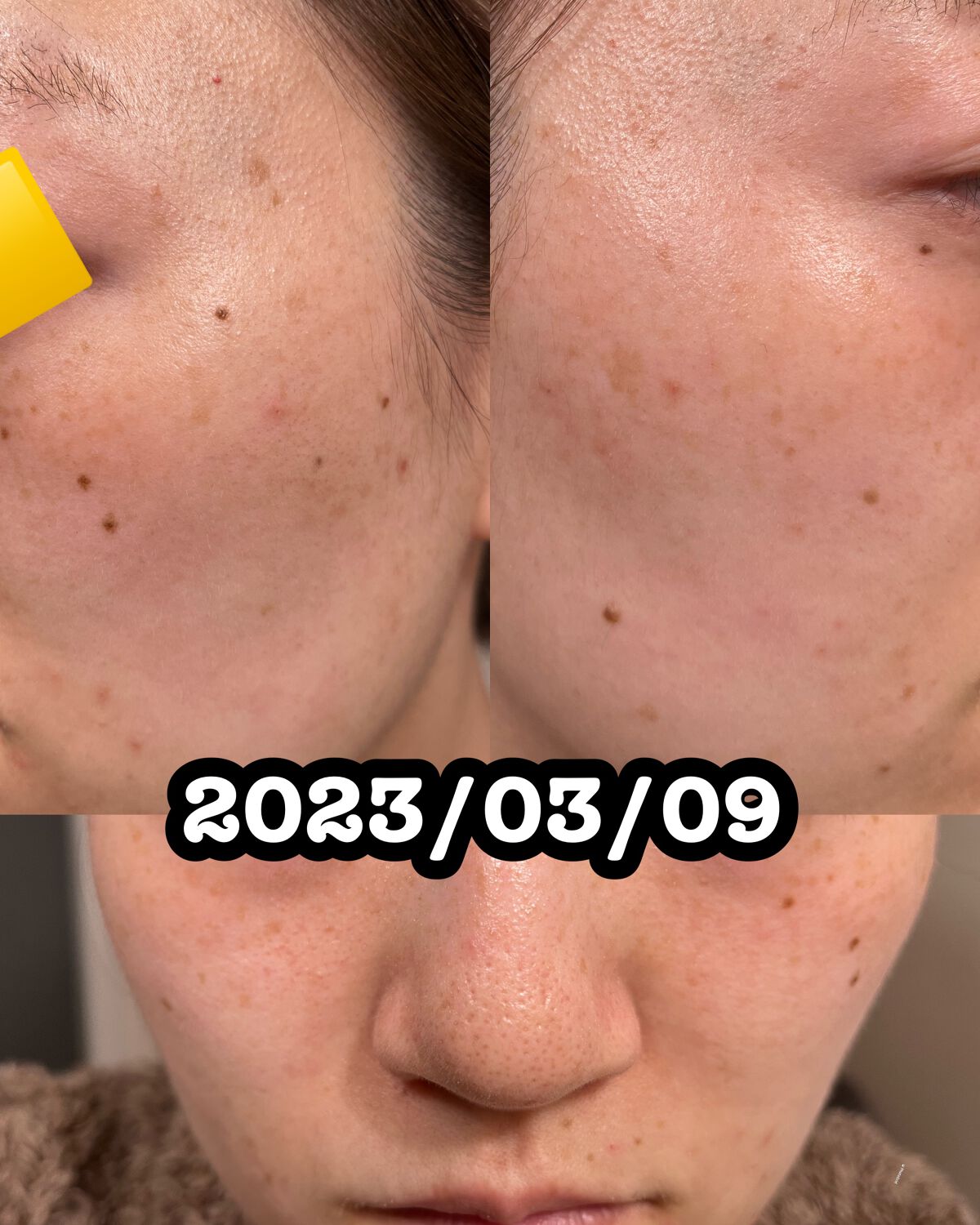 EUKROMA ハイドロキノンクリーム4% 20g/EUKROMA/その他スキンケアを使ったクチコミ(7枚目)