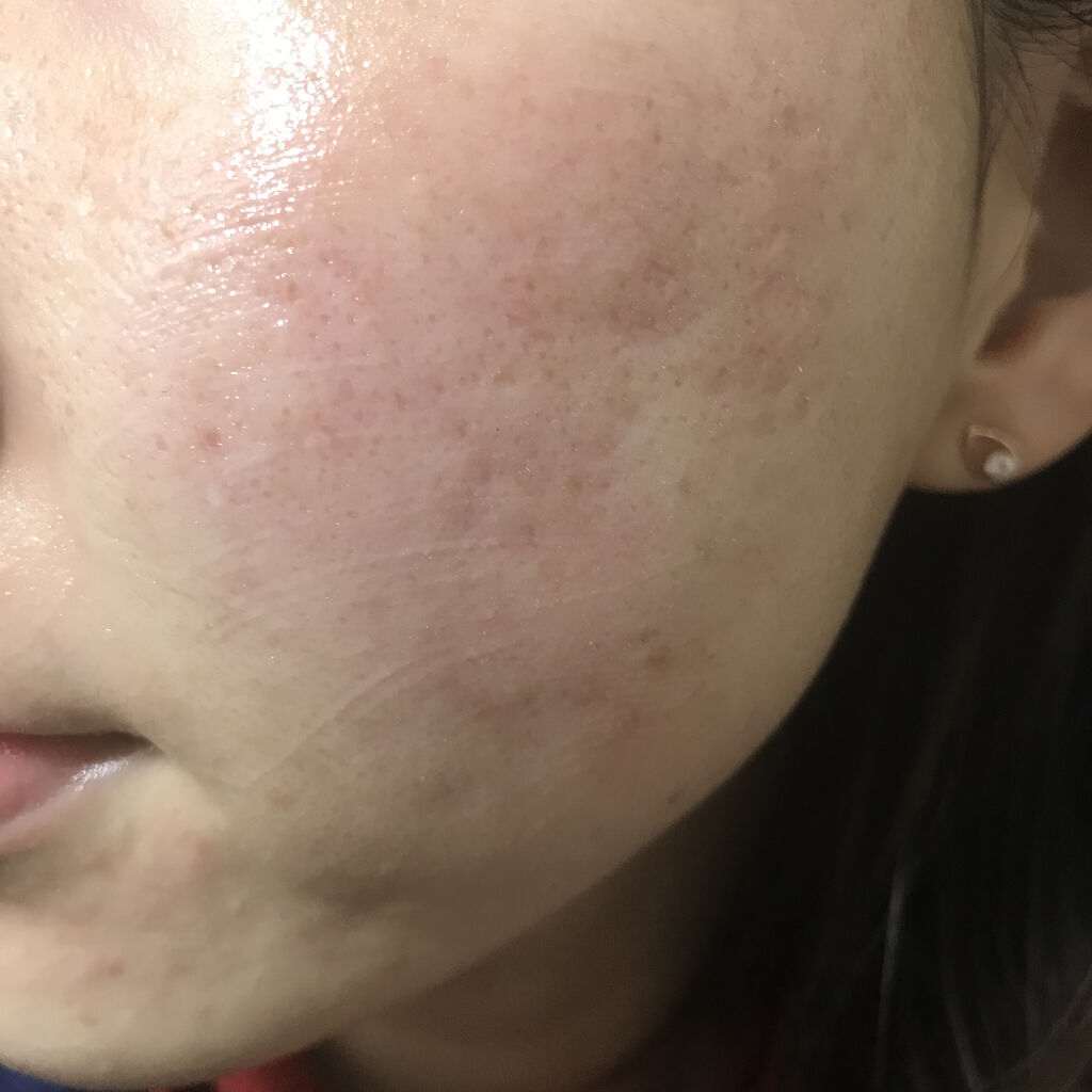 ティーツリーバイオーム ブレミッシュシカアンプル/MEDIHEAL/美容液を使ったクチコミ（2枚目）