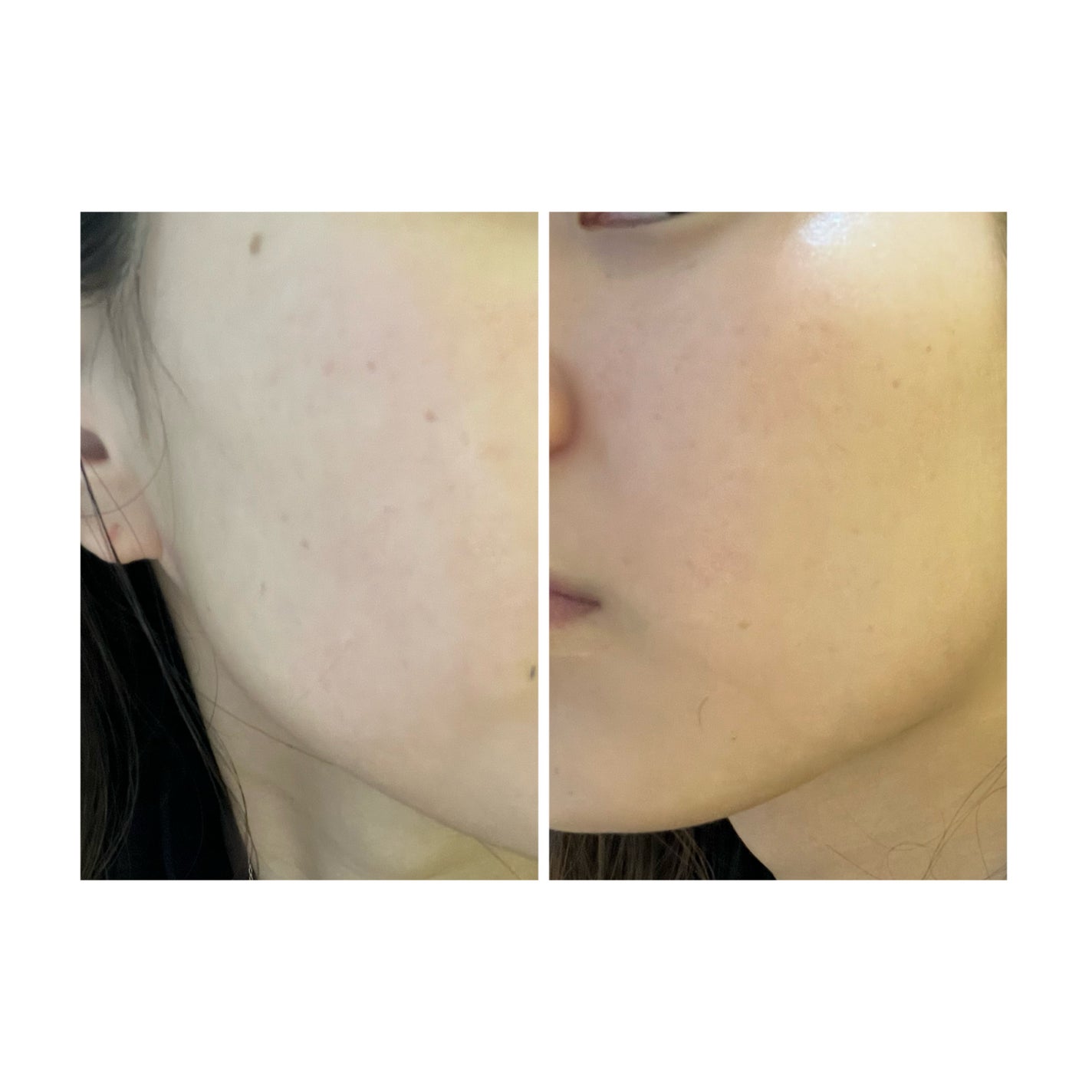 ぽむ on LIPS 「2023.9.13皮膚科に受診 エピデュオとヘパリン処方1枚目..」(2枚目)