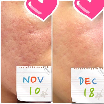 皮脂トラブルケア 泡洗顔料/キュレル/泡洗顔を使ったクチコミ(3枚目)