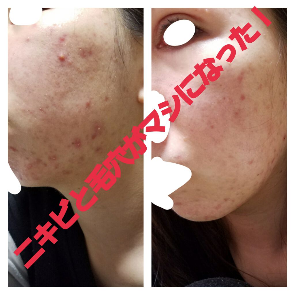 さりあ on LIPS 「こんにちは。以前LIPPSの皆様にお力を借り、ニキビ肌の改善に..」(1枚目)