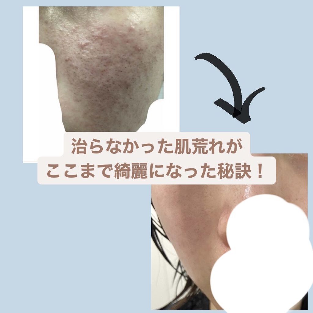 AC フェイスローション/NOV/化粧水を使ったクチコミ（1枚目）