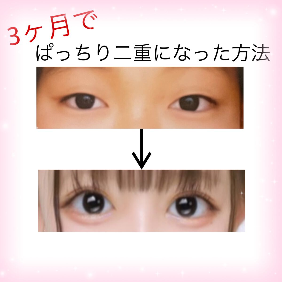 のびーるアイテープ(絆創膏タイプ、レギュラー)/DAISO/二重まぶた用アイテムを使ったクチコミ(1枚目)