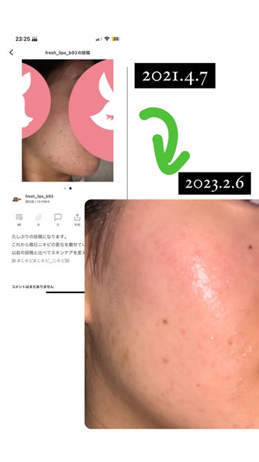 fresh_lips_b93 on LIPS 「皆さんお久しぶりです。約2年前の肌と比べてみました。結構肌改善..」（2枚目）