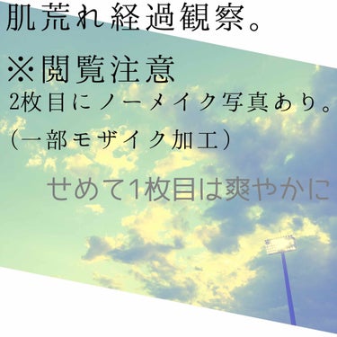 肌荒れ経過観察つけてみます
画像2枚目にノーメイク野郎いるのでご注意

沈静化したものの完治まで気を抜けない…

ニキビ跡も撲滅したい😇

#肌荒れ経過観察