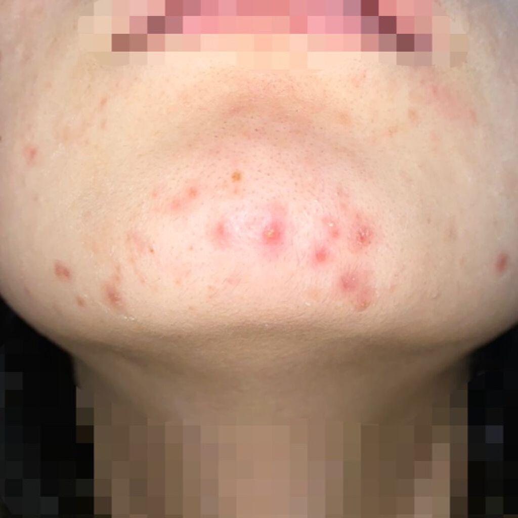 オキシドール(医薬品)/日本薬局方/その他を使ったクチコミ(4枚目)