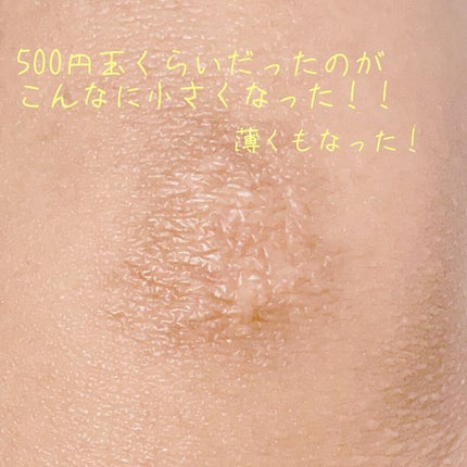 アットノン(医薬品)/アットノン/その他を使ったクチコミ(4枚目)