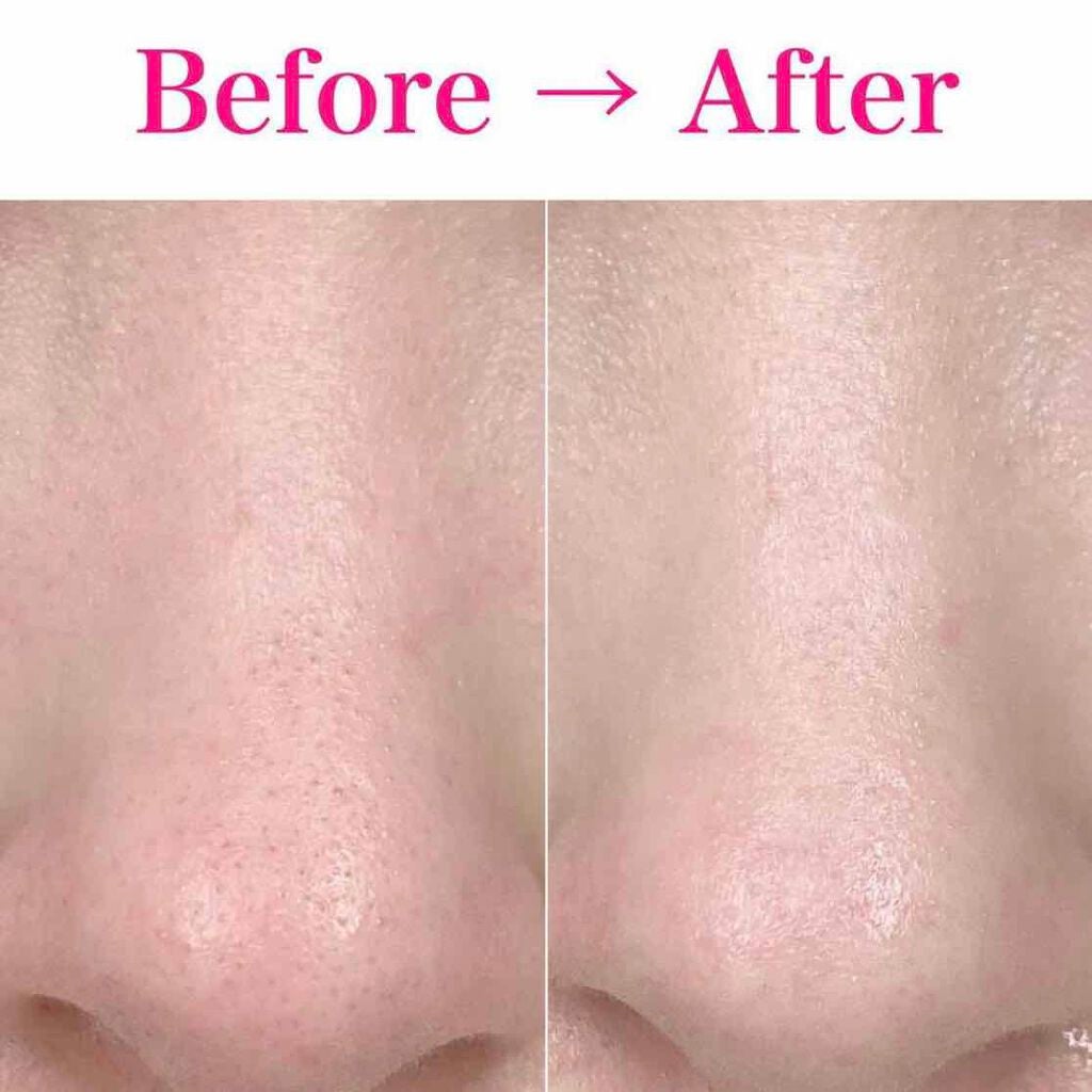 ブラック ヘッド ゼロ 2ステップ ノーズ パッチ/Dr.Althea/シートマスク・パックを使ったクチコミ(1枚目)