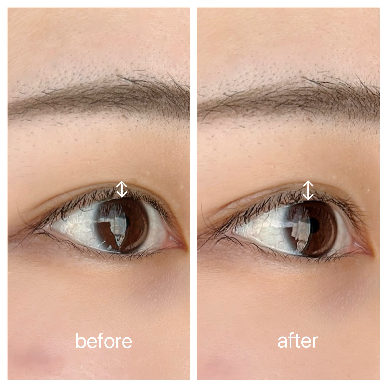 メザイク イージークリア 接着クリアタイプ/メザイク/二重まぶた用アイテムを使ったクチコミ（2枚目）