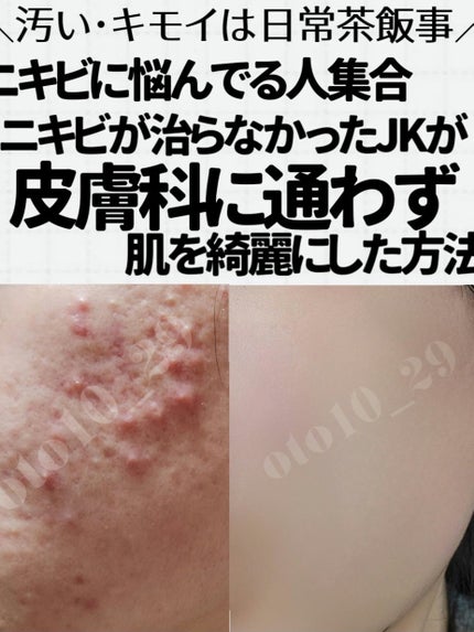 スキンケア洗顔料 薬用アクネケア/ビオレ/洗顔フォームを使ったクチコミ(1枚目)