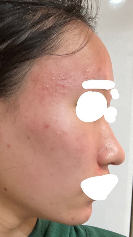 A アクネフォーム/NOV/洗顔フォームを使ったクチコミ(4枚目)