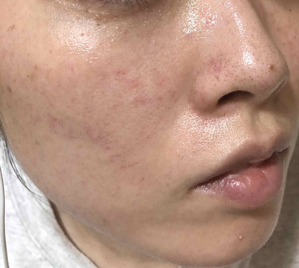 まな@YouTube on LIPS 「お肌改善計画第三弾です!💓🌈レーザー跡に塗る薬塗ってるのでテカ..」(2枚目)