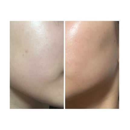 ぽむ on LIPS 「2023.9.13皮膚科に受診 エピデュオとヘパリン処方1枚目..」(5枚目)