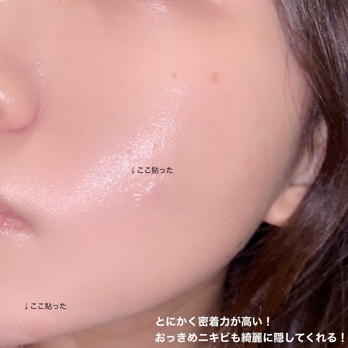 SOME BY MI 30デイズミラクルクリアスポットパッチのクチコミ「【触らない！潰さない！】
最強のニキビパッチを見つけてしまった！

サムバイミーのニキビパッチ.....」（2枚目）