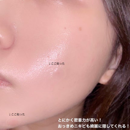 30デイズミラクルクリアスポットパッチ/SOME BY MI/にきびパッチを使ったクチコミ(2枚目)
