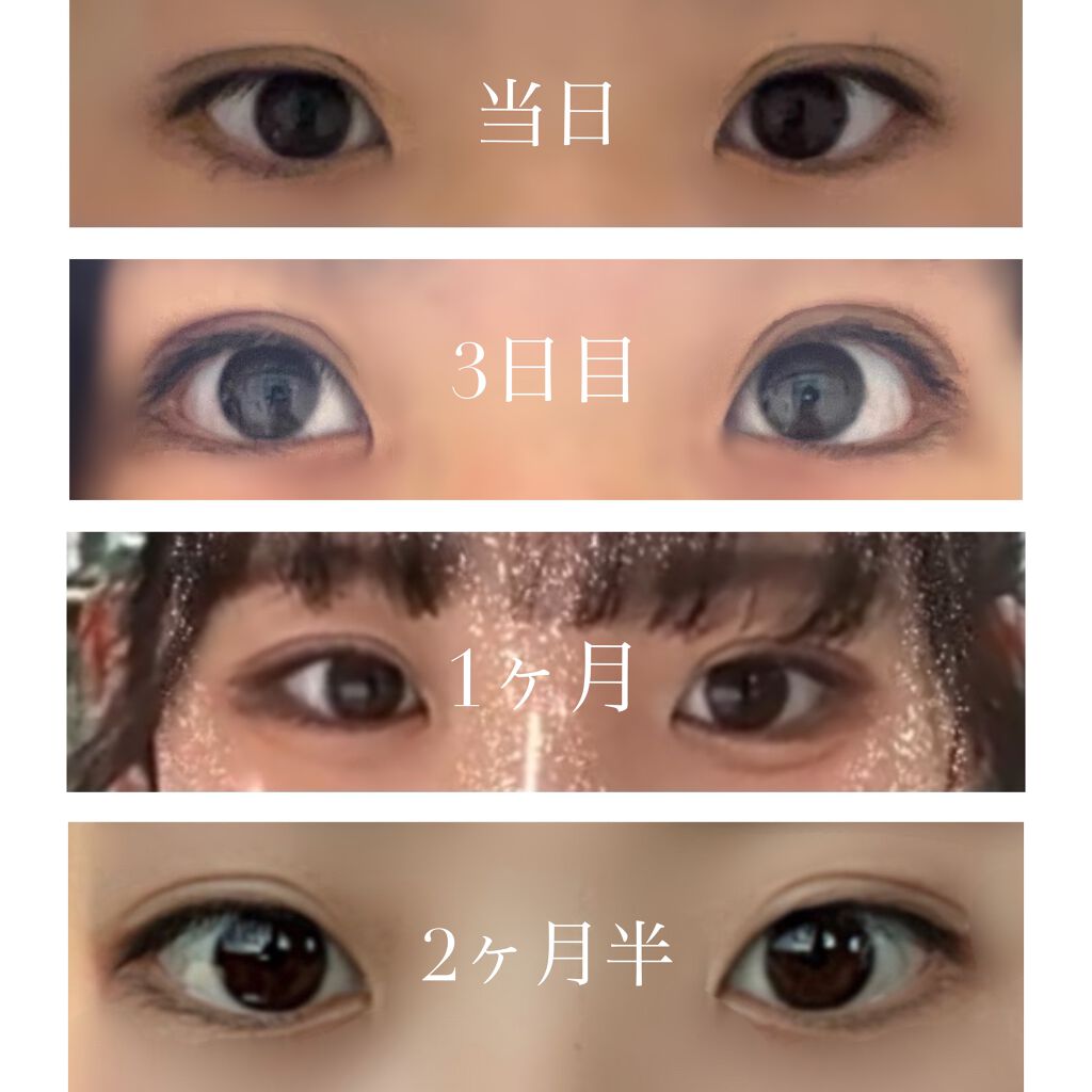 うめぼし on LIPS 「埋没から2ヶ月半経過!!更新おそくてごめんなさい🙏前回の投稿で..」(2枚目)