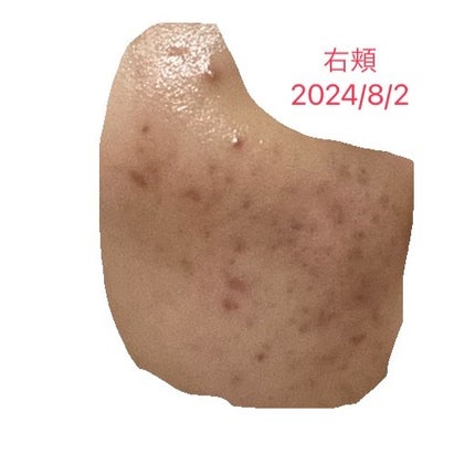 ぽよこ on LIPS 「2024/8/2頬と額のニキビ、ニキビ跡が酷くて治りません。も..」(1枚目)