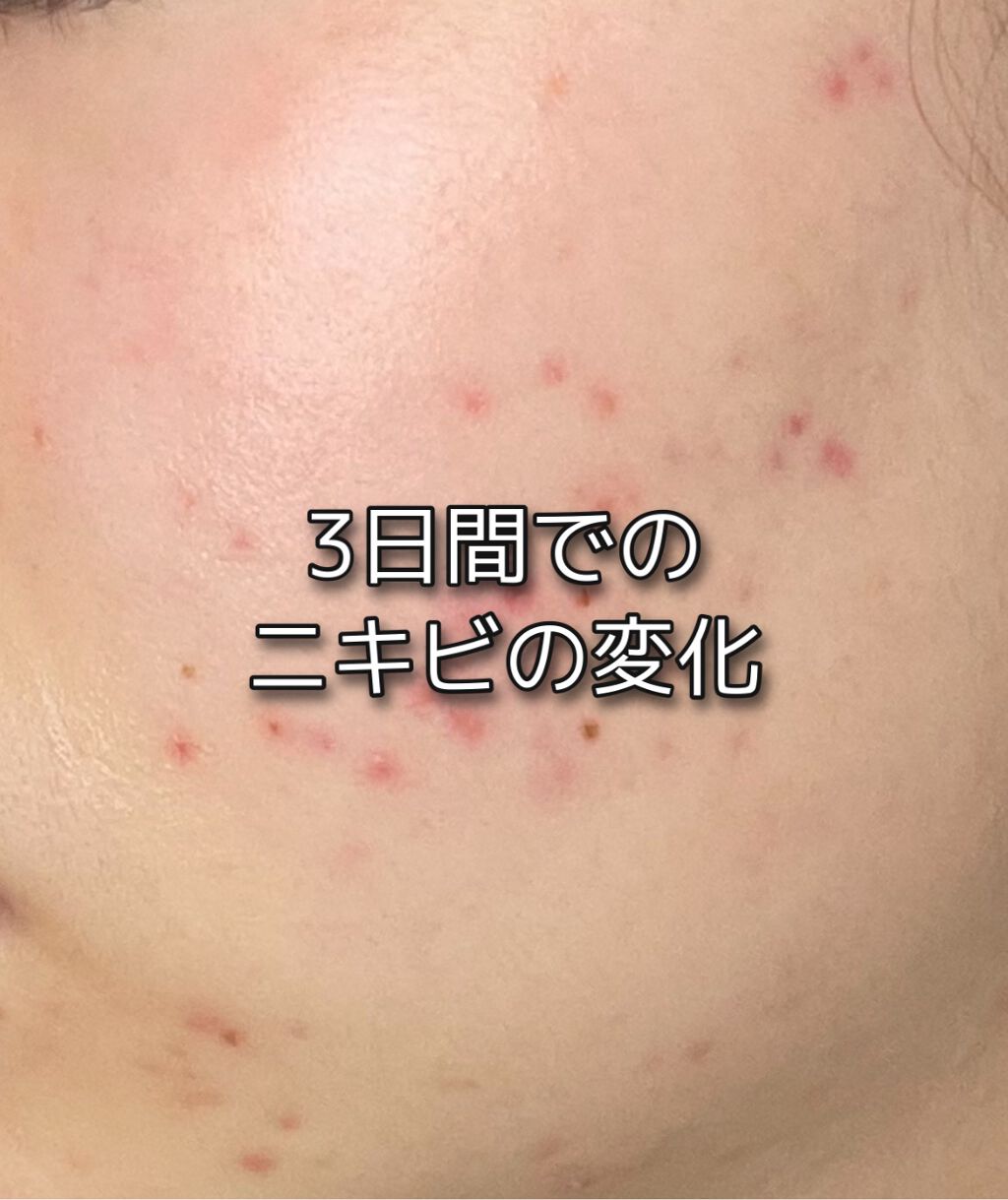 イハダ 薬用バーム【医薬部外品】/IHADA/フェイスバームを使ったクチコミ(1枚目)