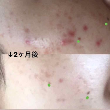 彩花 on LIPS 「1枚目はSODAで撮ったので加工ありです🤒2枚目は無加工のカメ..」（2枚目）