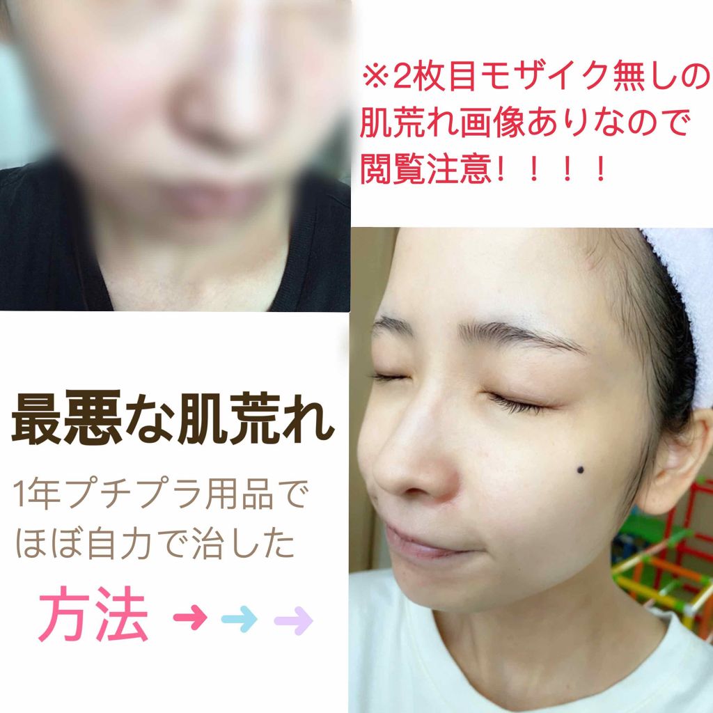 なあさん。▷LIPSパートナー on LIPS 「※汚肌閲覧注意今すごく汚肌に悩んでる人がほんの少しでも希望を持..」(1枚目)