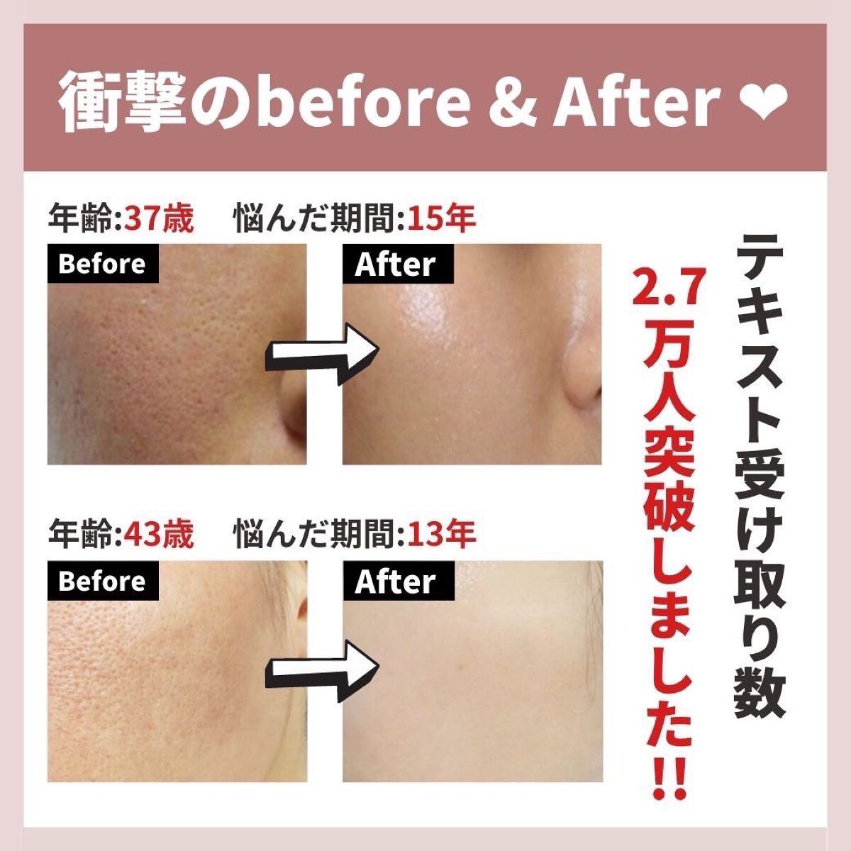 あなたの肌に合ったスキンケア💐コーくん先生 on LIPS 「【本当にやめて!】こんな人は毛穴の開き一生消えません。..あな..」(7枚目)