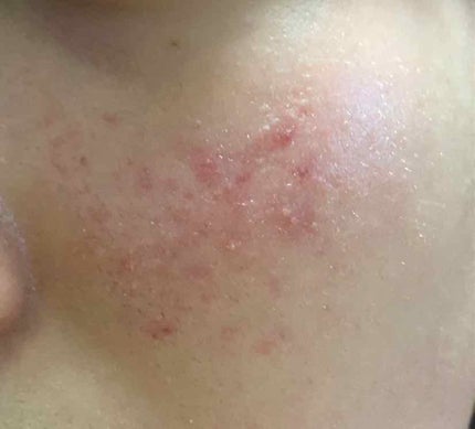 aoi on LIPS 「中学三年です。小6頃からニキビが出来始め今は写真の様な肌になっ..」(3枚目)