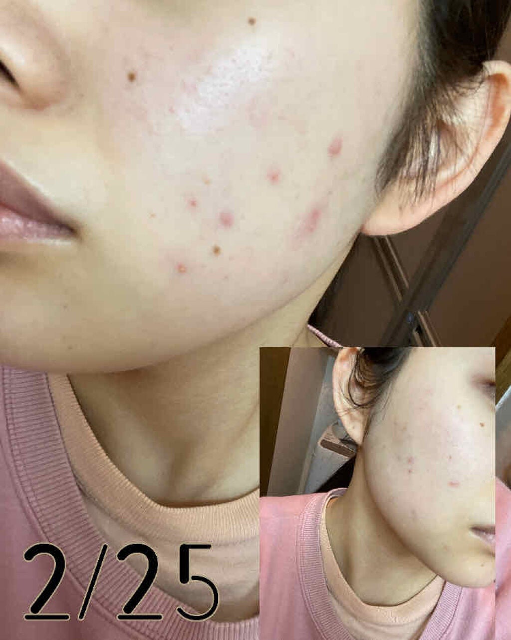 ゆんん on LIPS 「🙋♀️大人ニキビ⭐️現象12月下旬から1月中旬小さいニキビが..」(2枚目)