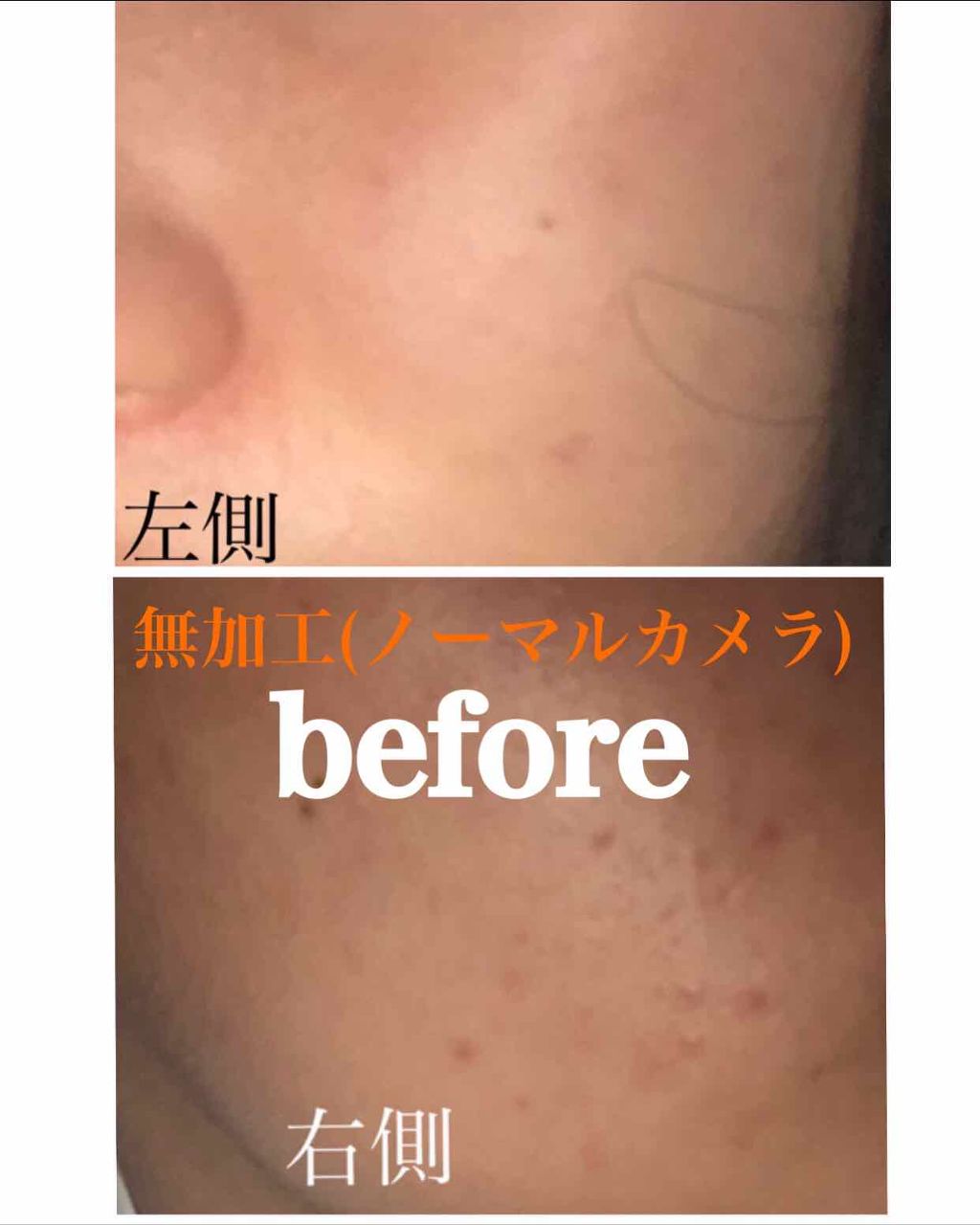 ブタゴリラ産 on LIPS 「〜🌱肌日記🌱〜#最近のスキンケア#ニキビ跡#ニキビ#牛乳石鹸ニ..」(1枚目)