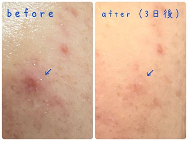 Neutrogena Rapid Clear Stubborn Acne Spot Treatment Gelのクチコミ「〜ニュートロジーナラピッドクリア 
スタバーン・アクネ スポットジェル〜

【商品説明】
簡単.....」（2枚目）