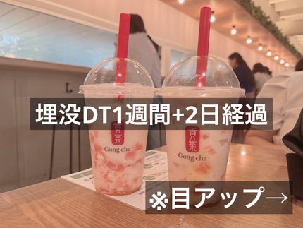 みこた@フォロバ on LIPS 「15日にやったので9日が経過しました!まだ腫れてるけど内出血等..」(1枚目)