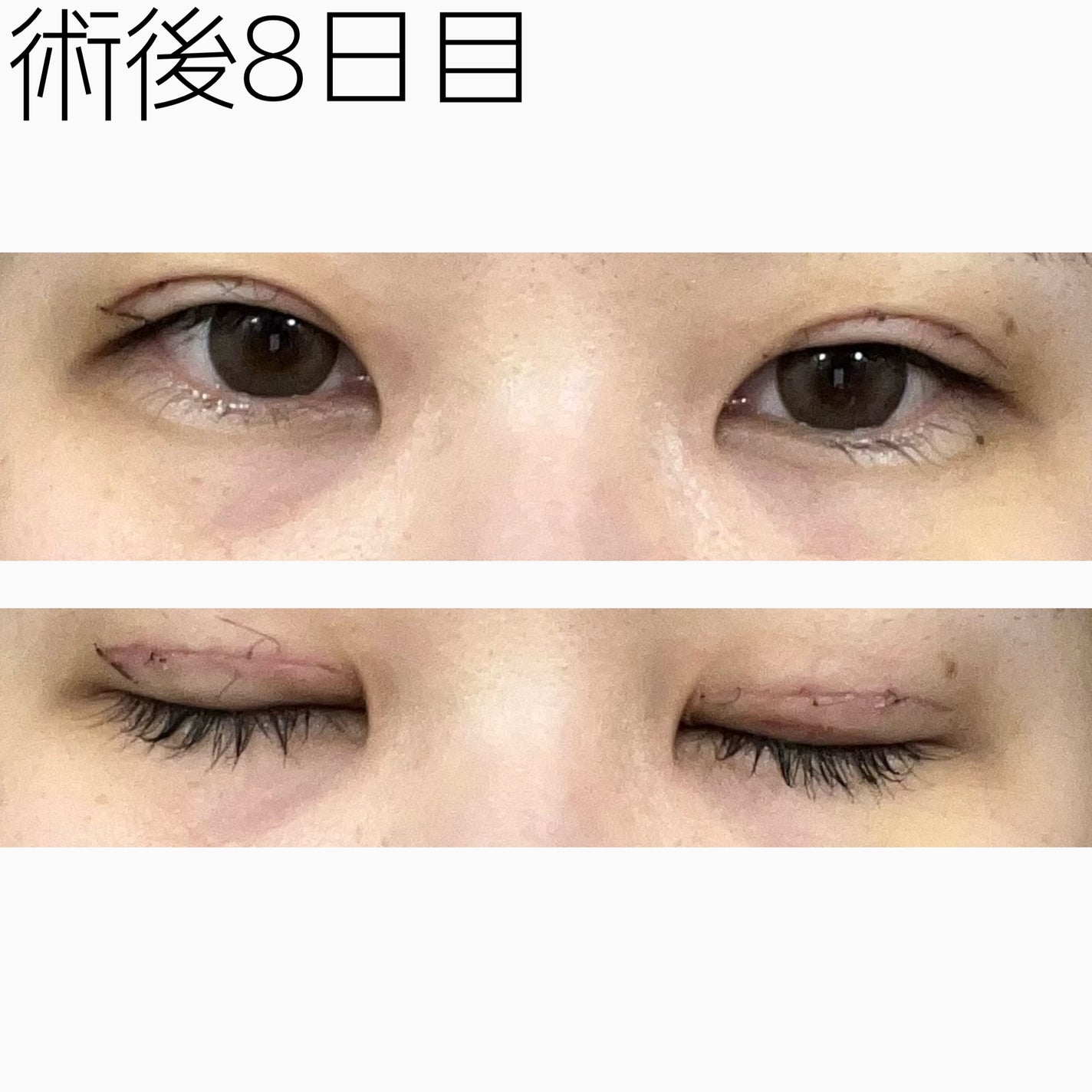 NANO@フォロバ! on LIPS 「二重整形ダウンタイム記録/まだまだ触ると敏感な感じはしますがら..」(2枚目)