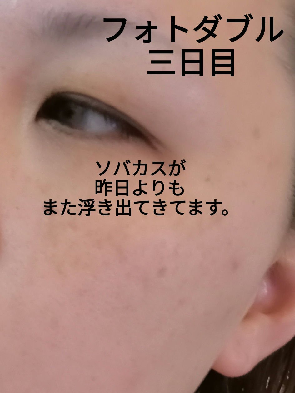 フォトダブル/湘南美容クリニック/その他を使ったクチコミ（1枚目）