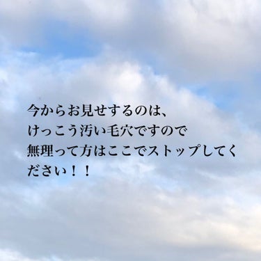 ちふれ ふきとり化粧水のクチコミ「こんにちは、皆さんに助けて欲しいです！（ ;  ; ）


私はずっと毛穴に悩んでいて、色々試.....」（2枚目）