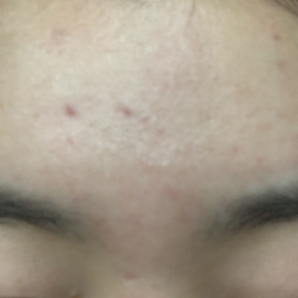 クリンダマイシンゲル(医薬品)/クラシエ薬品/その他を使ったクチコミ（3枚目）