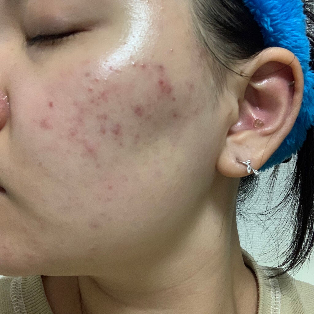 ティーツリーケア ソリューション エッセンシャルマスクEX/MEDIHEAL/シートマスク・パックを使ったクチコミ(2枚目)