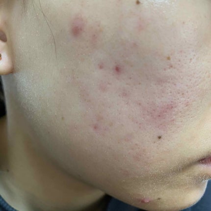 ãŒãã¢ãã¯ã¹(å»è¬å)/ãã«ãæ ªåŒäŒç€Ÿ/ãã®ä»ã䜿ã£ãã¯ãã³ãïŒ1æç®ïŒ