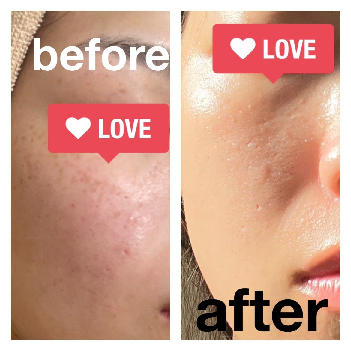 レチノールA 1% アドバンスドリバイタリゼーションクリーム/Life-flo/フェイスクリームを使ったクチコミ(5枚目)