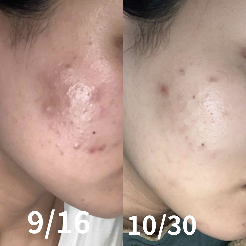 目指せノーファンデ on LIPS 「ニキビ治療記録お見苦しいところ失礼します。9月に比べるとやはり..」(1枚目)