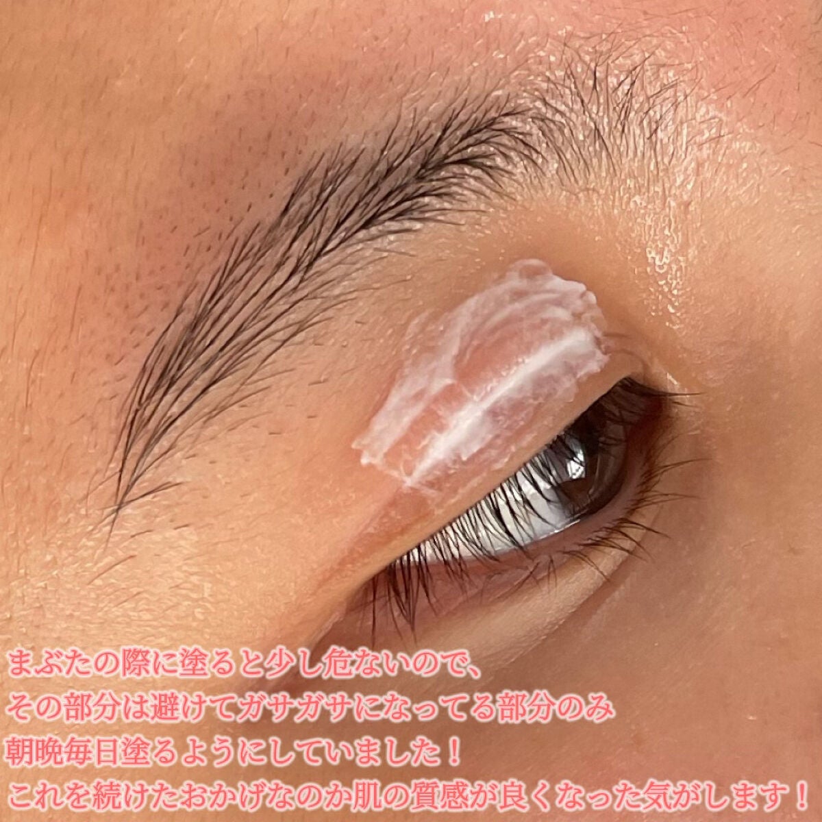 ピアソンHPクリーム(医薬品)/ピアソンHP/その他を使ったクチコミ(4枚目)