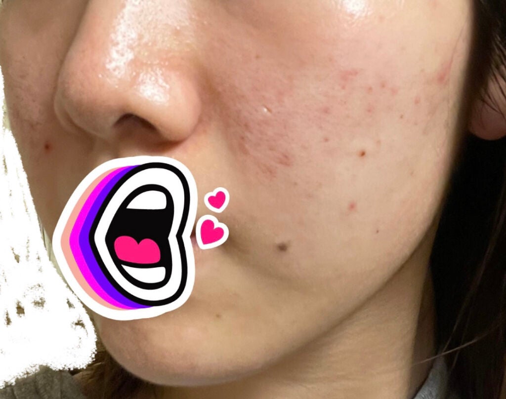 オードムーゲ 薬用ローション(ふきとり化粧水)/オードムーゲ/拭き取り化粧水を使ったクチコミ(2枚目)