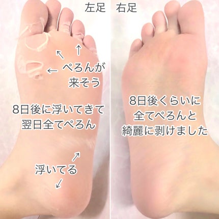 あしやすめ 足裏角質ケアパック/鎌倉ライフ/レッグ・フットケアを使ったクチコミ(5枚目)