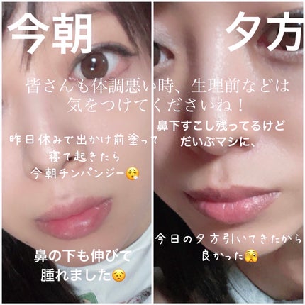 まりにゃむ🪼 on LIPS 「悲報!!!今まで大丈夫だったのに、プランパーで唇だけじゃなく、..」(2枚目)