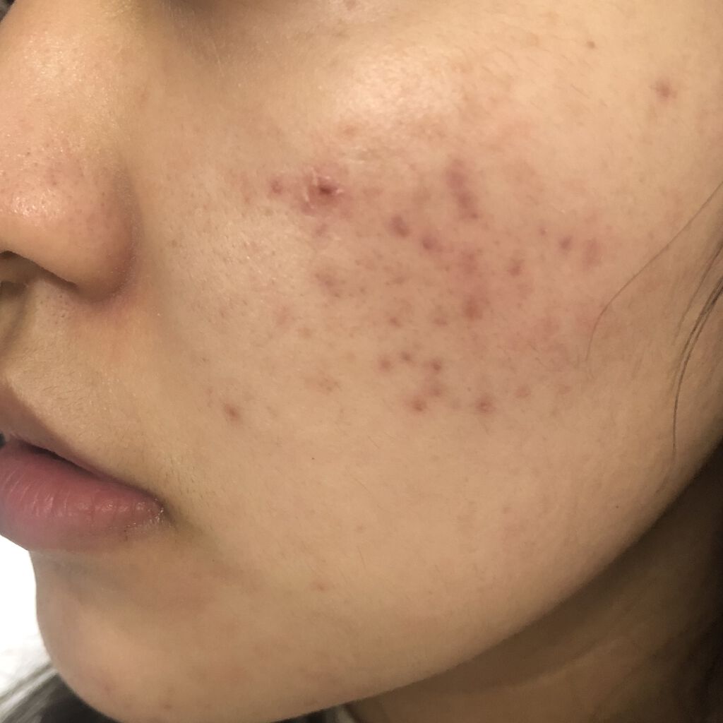 薬用 しみ 集中対策 美容液/メラノCC/美容液を使ったクチコミ（1枚目）