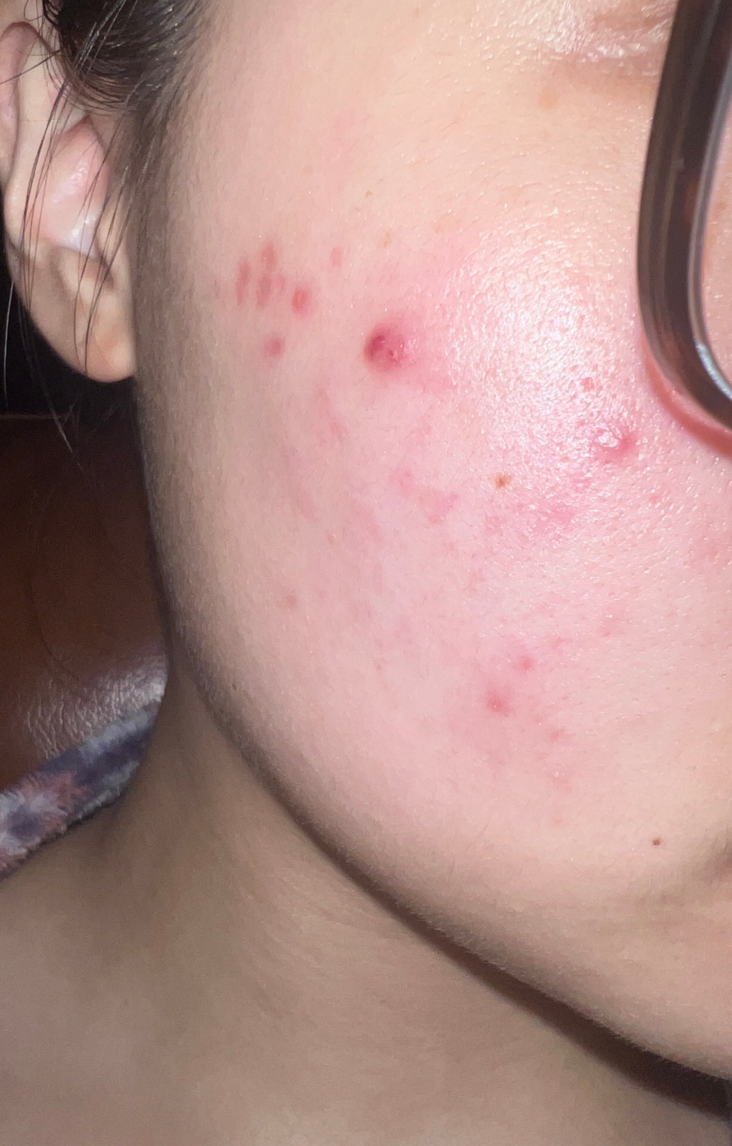 オードムーゲ 薬用ローション(ふきとり化粧水)/オードムーゲ/拭き取り化粧水を使ったクチコミ(1枚目)