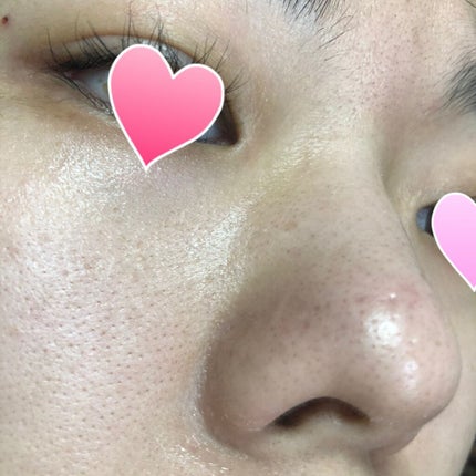 Mikity on LIPS 「超音波ウォーターピーリング美顔器買いました‼️毛穴、いちご鼻が..」(8枚目)