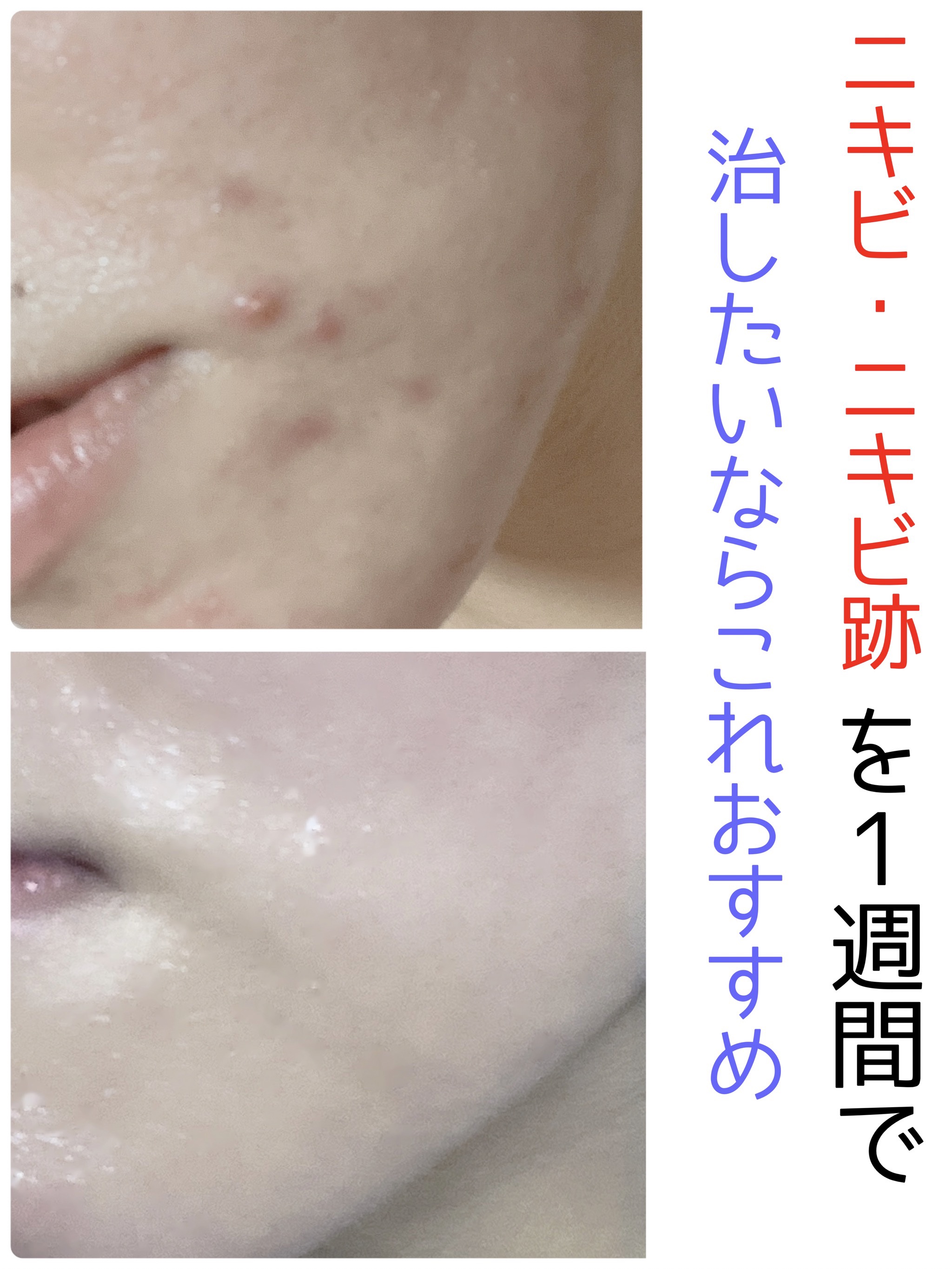 SOME BY MI ミラクルアクネクリアスポットトリートメントのクチコミ「

ホルモンバランスの乱れで
久しぶりにニキビがポツポツできてしまったので
試してみました！
.....」（1枚目）