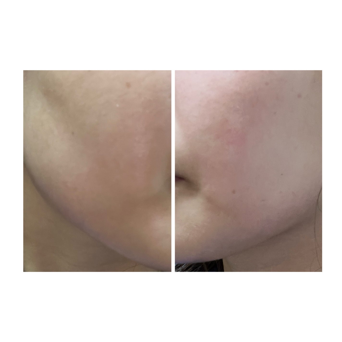 ぽむ on LIPS 「2023.9.13皮膚科に受診 エピデュオとヘパリン処方1枚目..」(5枚目)