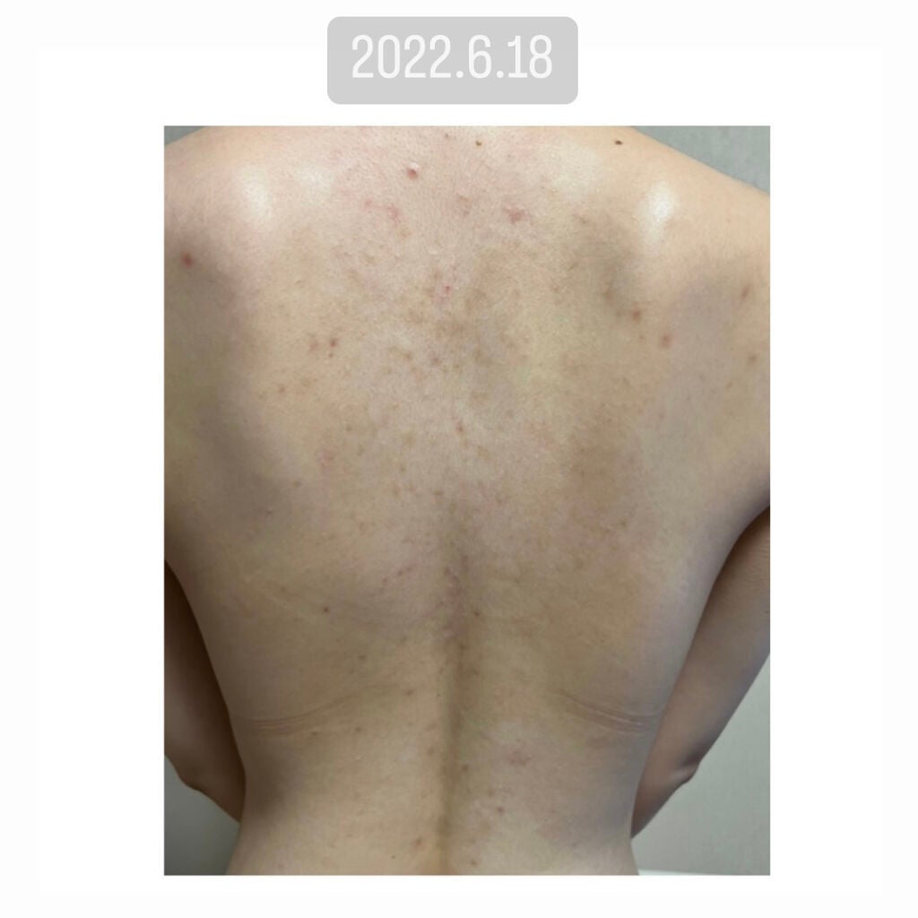 ニキビを防ぐ薬用石鹸 ForBack/ペリカン石鹸/ボディ石鹸を使ったクチコミ(6枚目)