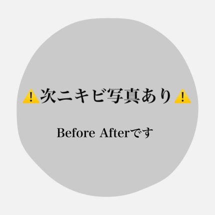 メンズアクネクリア 薬用コンシーラー ナチュラル/石澤研究所/スティックコンシーラーを使ったクチコミ(3枚目)